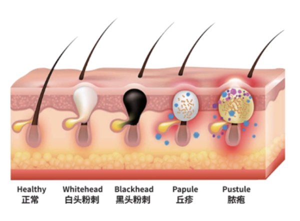迎客松配资 健康新知｜长痘啦？吃辣不背锅